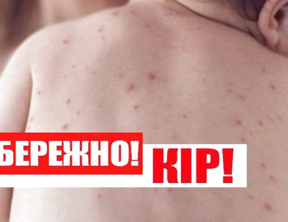  Майже 44 тисячі українців захворіли на кір, 16 померли